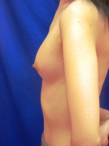 ⑤術後1ヶ月　左側面